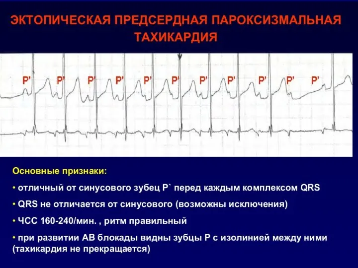 Пароксизмальная суправентрикулярная тахикардия внезапно начинающийся приступ сердцебиения, импульсы для которого