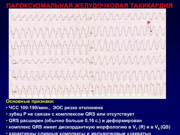 Пароксизмальная желудочковая тахикардия внезапно начинающийся приступ сердцебиения, импульсы для которого