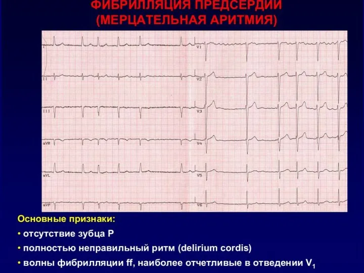 ФИБРИЛЛЯЦИЯ ПРЕДСЕРДИЙ МЕХАНИЗМЫ РАЗВИТИЯ ФП Повышение автоматизма в одном или