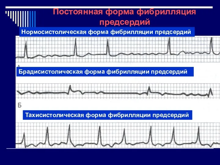 Нормосистолическая форма фибрилляции предсердий Брадисистолическая форма фибрилляции предсердий Тахисистолическая форма фибрилляции предсердий Постоянная форма фибрилляция предсердий