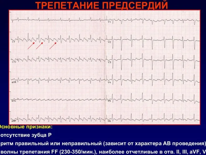 ГЕМОДИНАМИЧЕСКИЕ ПОСЛЕДСТВИЯ ФП 3 фактора могут влиять на гемодинамику при