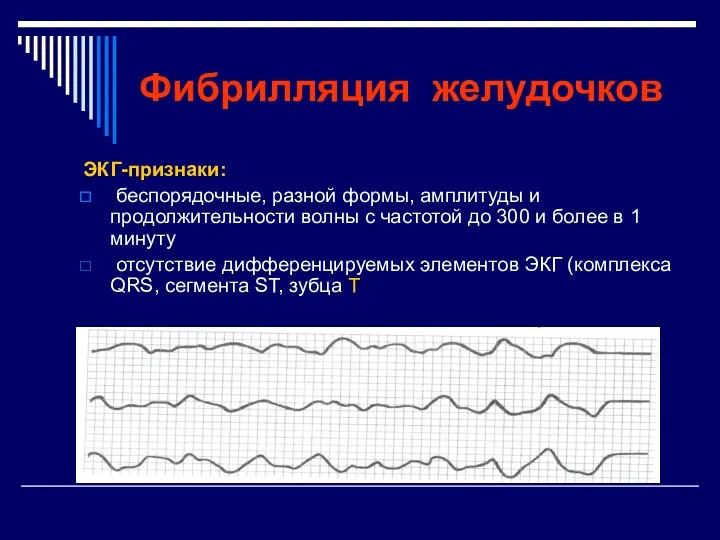 Фибрилляция желудочков ЭКГ-признаки: беспорядочные, разной формы, амплитуды и продолжительности волны