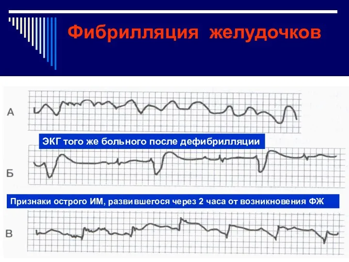 ЭКГ того же больного после дефибрилляции Признаки острого ИМ, развившегося