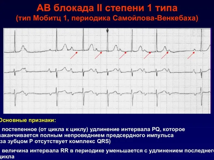 АВ-блокада II степени (неполная АВ-блокада) часть предсердных (синусовых) импульсов не проводятся на желудочки