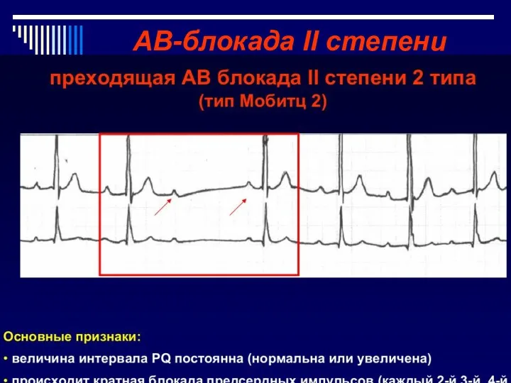 АВ-блокада II степени Неполная АВ-блокада I типа (по Мобитц), с