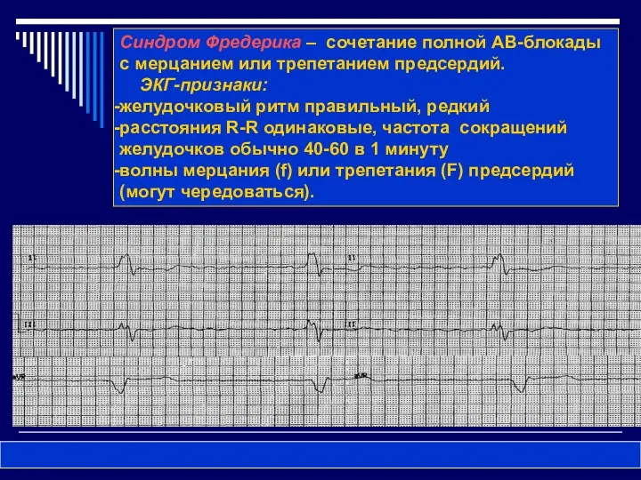 Синдром Фредерика – сочетание полной АВ-блокады с мерцанием или трепетанием