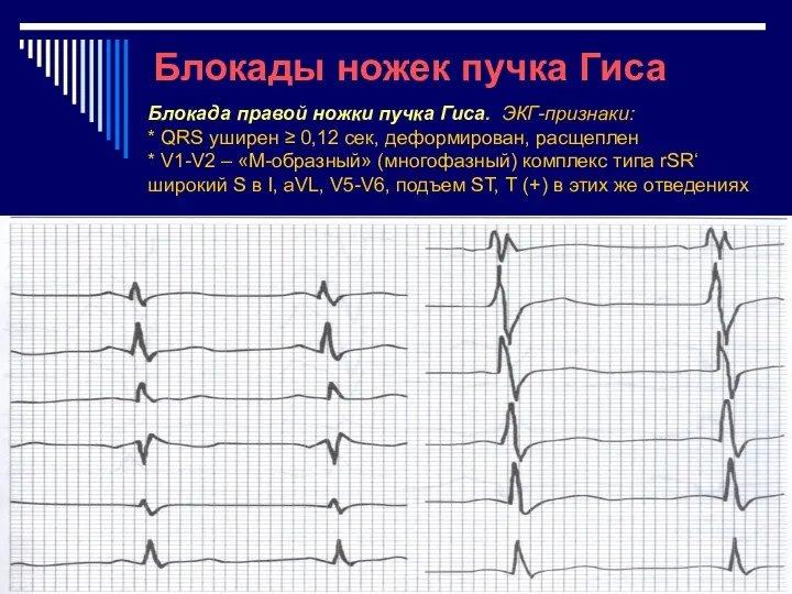 Блокады ножек пучка Гиса Блокада правой ножки пучка Гиса. ЭКГ-признаки: