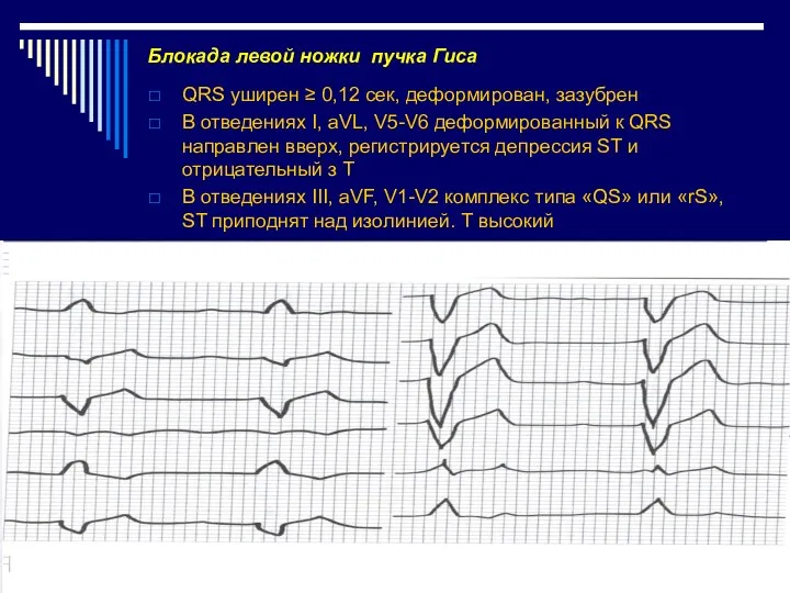 Блокада левой ножки пучка Гиса QRS уширен ≥ 0,12 сек,