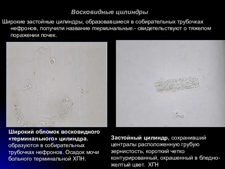 Восковидные цилиндры Широкие застойные цилиндры, образовавшиеся в собирательных трубочках нефронов,