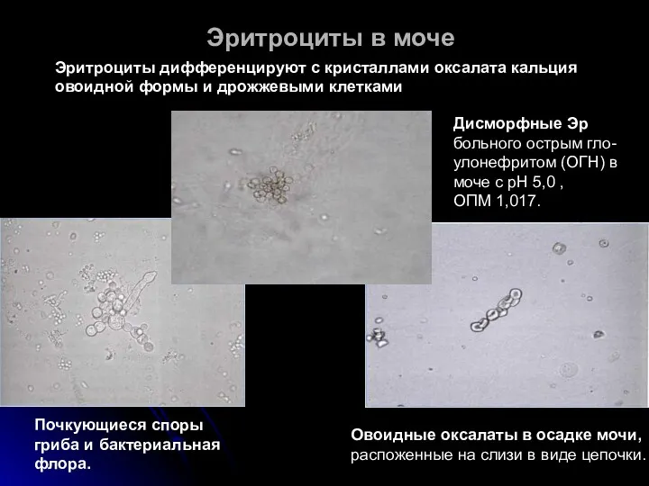 Эритроциты в моче Почкующиеся споры гриба и бактериальная флора. Овоидные