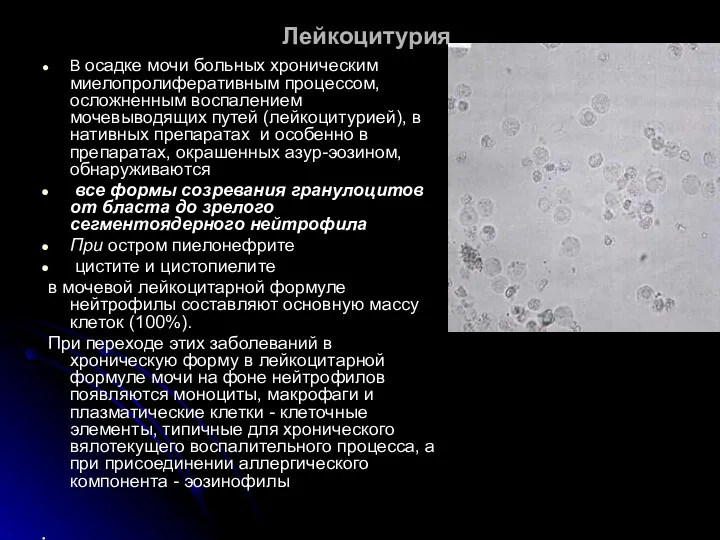 Лейкоцитурия В осадке мочи больных хроническим миелопролиферативным процессом, осложненным воспалением