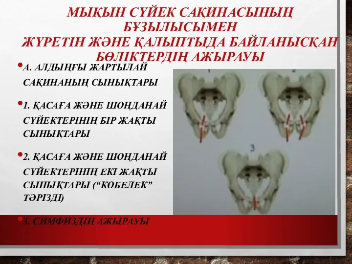 МЫҚЫН СҮЙЕК САҚИНАСЫНЫҢ БҰЗЫЛЫСЫМЕН ЖҮРЕТІН ЖӘНЕ ҚАЛЫПТЫДА БАЙЛАНЫСҚАН БӨЛІКТЕРДІҢ АЖЫРАУЫ А. АЛДЫҢҒЫ ЖАРТЫЛАЙ