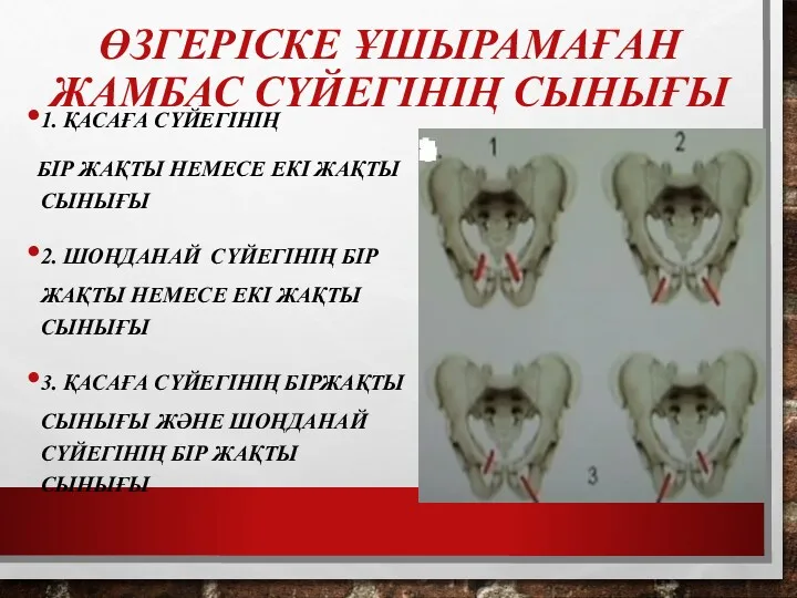 ӨЗГЕРІСКЕ ҰШЫРАМАҒАН ЖАМБАС СҮЙЕГІНІҢ СЫНЫҒЫ 1. ҚАСАҒА СҮЙЕГІНІҢ БІР ЖАҚТЫ НЕМЕСЕ ЕКІ ЖАҚТЫ