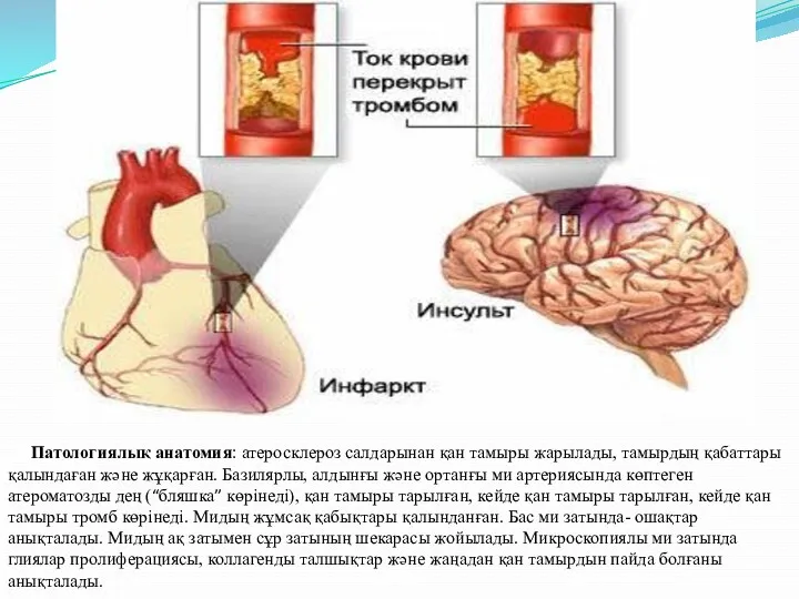 Патологиялық анатомия: атеросклероз салдарынан қан тамыры жарылады, тамырдың қабаттары қалындаған