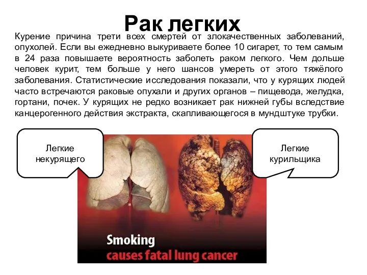 Рак легких Курение причина трети всех смертей от злокачественных заболеваний,