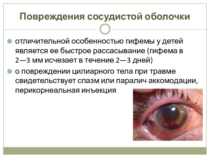 Повреждения сосудистой оболочки отличительной особенностью гифемы у детей является ее