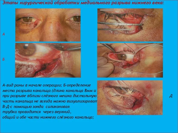 Этапы хирургической обработки медиального разрыва нижнего века: А Б Б
