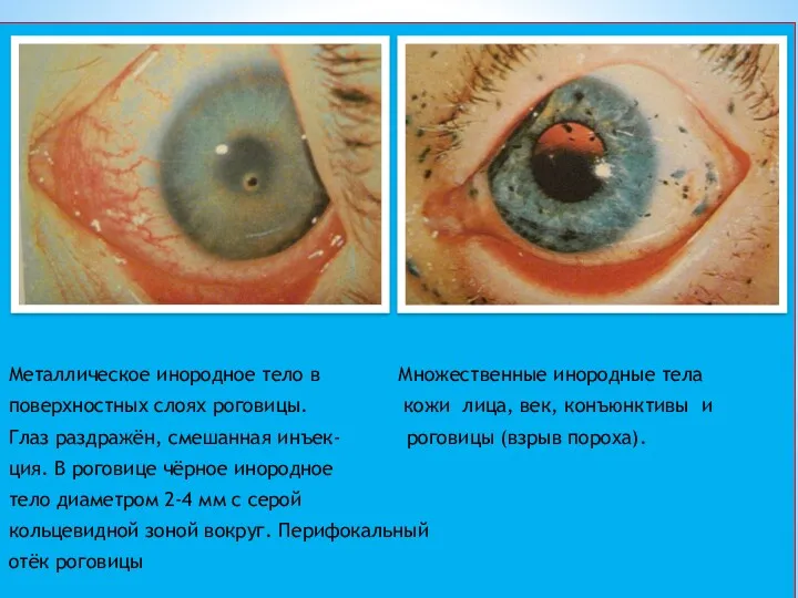Металлическое инородное тело в Множественные инородные тела поверхностных слоях роговицы.