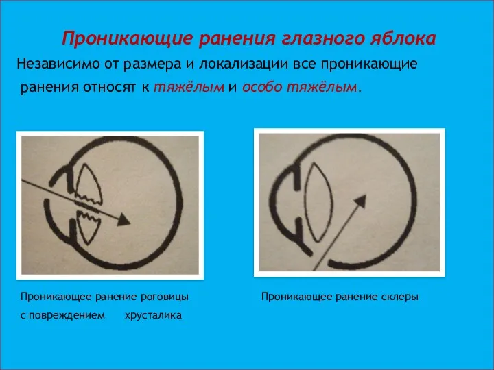 Проникающие ранения глазного яблока Независимо от размера и локализации все