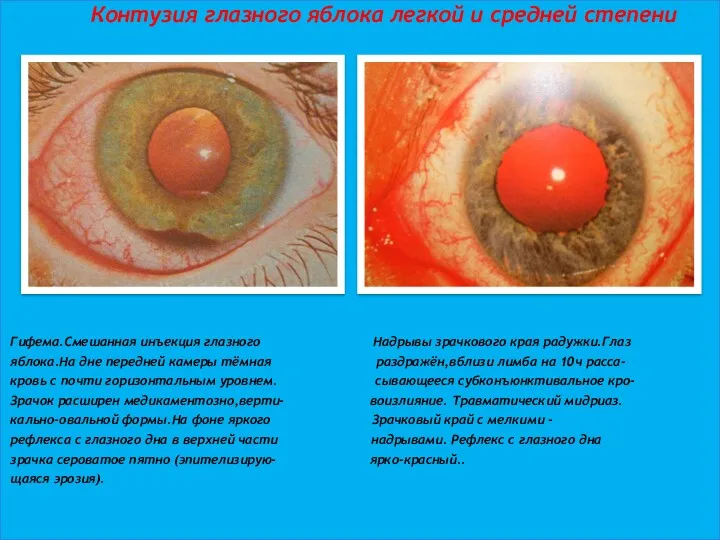 Контузия глазного яблока легкой и средней степени Гифема.Смешанная инъекция глазного