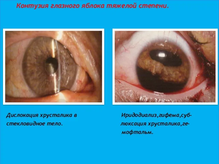 Контузия глазного яблока тяжелой степени. Дислокация хрусталика в Иридодиализ,гифема,суб- стекловидное тело. люксация хрусталика,ге- мофтальм.