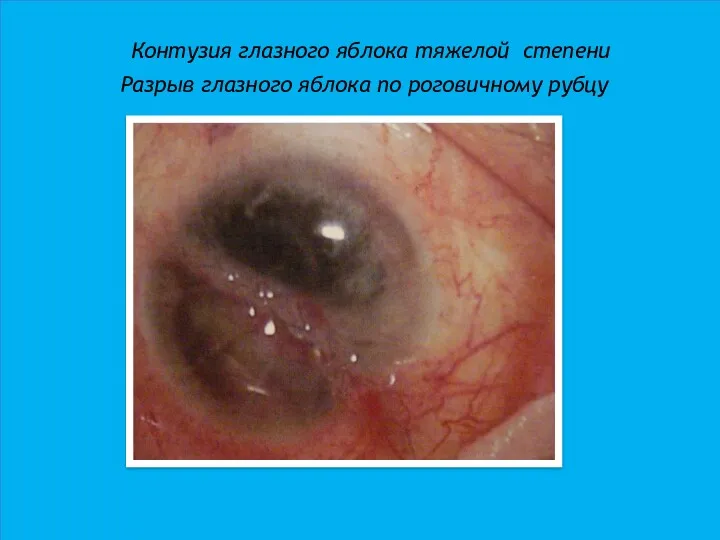 Контузия глазного яблока тяжелой степени Разрыв глазного яблока по роговичному рубцу