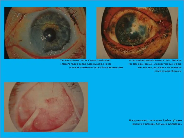 Химический ожог глаза. Слизистая оболочка Исход комбинированного ожога глаза. Помутне-