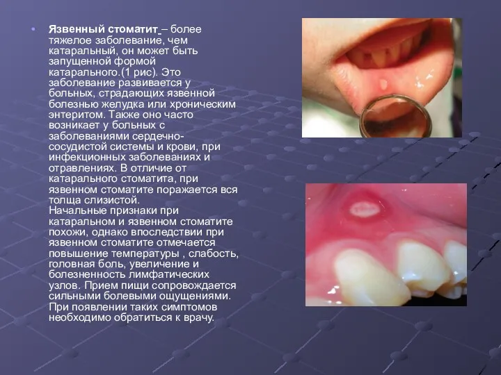 Язвенный стоматит – более тяжелое заболевание, чем катаральный, он может быть запущенной формой