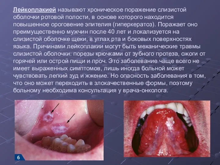 Лейкоплакией называют хроническое поражение слизистой оболочки ротовой полости, в основе которого находится повышенное