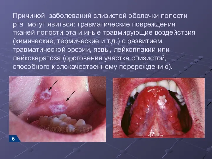 Причиной заболеваний слизистой оболочки полости рта могут явиться: травматические повреждения тканей полости рта