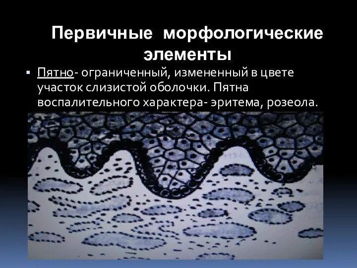 Первичные морфологические элементы Пятно- ограниченный, измененный в цвете участок слизистой оболочки. Пятна воспалительного характера- эритема, розеола.