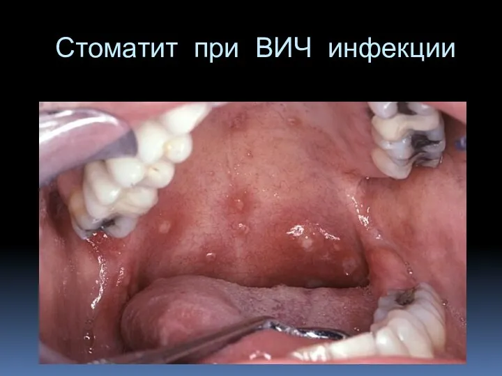 Стоматит при ВИЧ инфекции