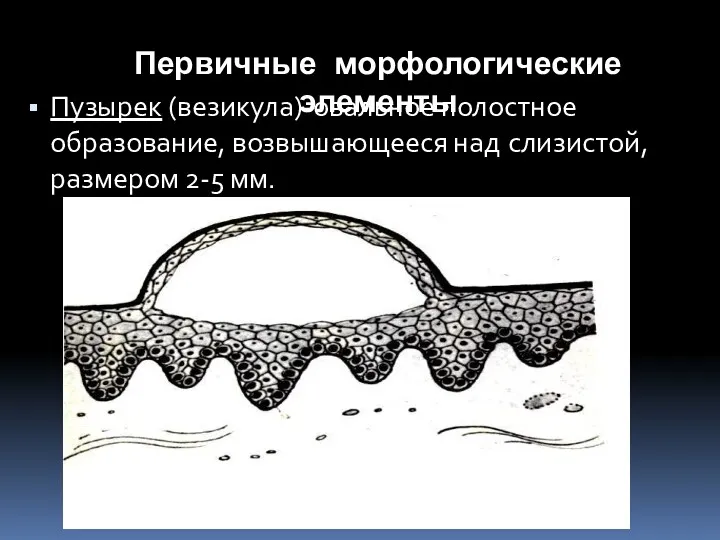 Первичные морфологические элементы Пузырек (везикула)-овальное полостное образование, возвышающееся над слизистой, размером 2-5 мм.