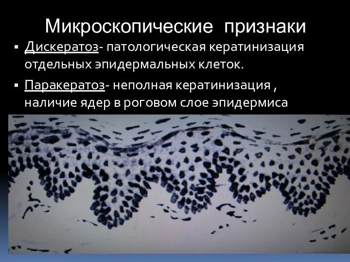 Микроскопические признаки Дискератоз- патологическая кератинизация отдельных эпидермальных клеток. Паракератоз- неполная