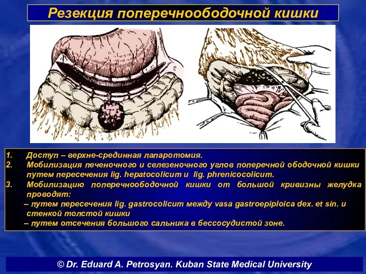 Резекция поперечноободочной кишки Доступ – верхне-срединная лапаротомия. Мобилизация печеночного и