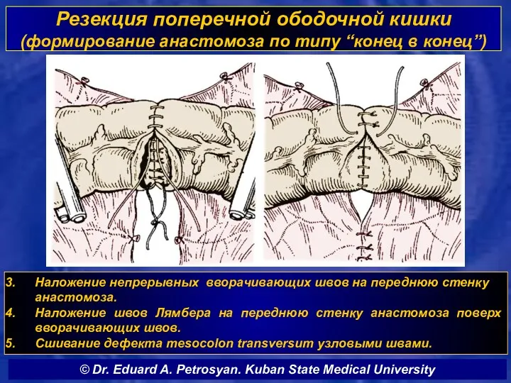 Резекция поперечной ободочной кишки (формирование анастомоза по типу “конец в