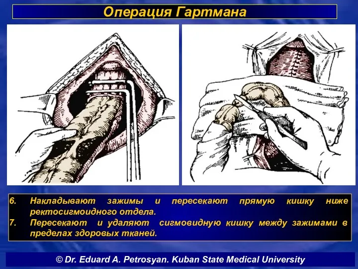 Операция Гартмана Накладывают зажимы и пересекают прямую кишку ниже ректосигмоидного