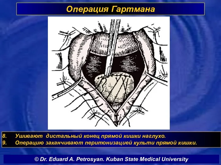 Операция Гартмана Ушивают дистальный конец прямой кишки наглухо. Операцию заканчивают