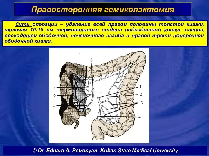 Правосторонняя гемиколэктомия Cуть операции – удаление всей правой половины толстой