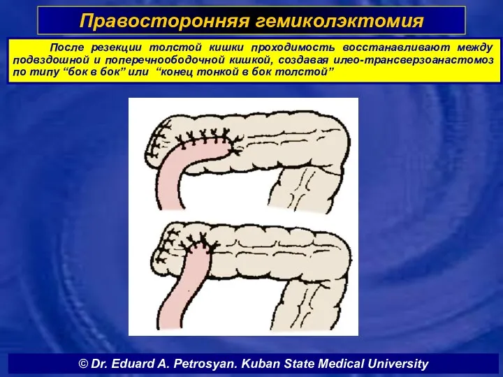 Правосторонняя гемиколэктомия После резекции толстой кишки проходимость восстанавливают между подвздошной