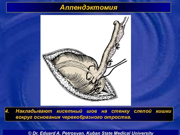 Аппендэктомия Накладывают кисетный шов на стенку слепой кишки вокруг основания