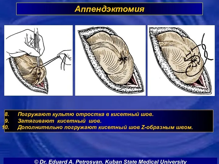 Аппендэктомия Погружают культю отростка в кисетный шов. Затягивают кисетный шов.