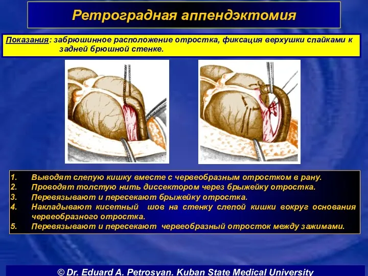 Ретроградная аппендэктомия Выводят слепую кишку вместе с червеобразным отростком в