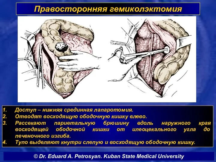 Правосторонняя гемиколэктомия Доступ – нижняя срединная лапаротомия. Отводят восходящую ободочную