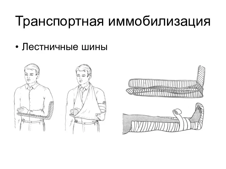 Транспортная иммобилизация Лестничные шины