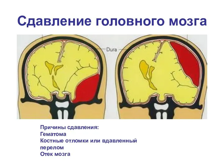 Сдавление головного мозга Причины сдавления: Гематома Костные отломки или вдавленный перелом Отек мозга