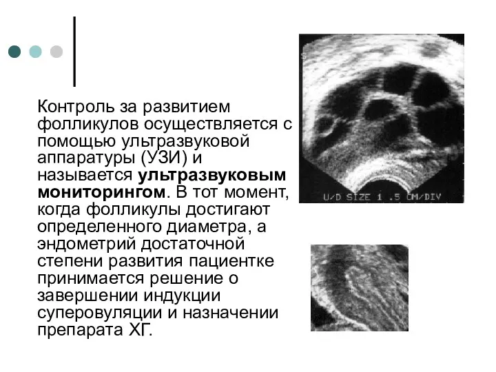 Контроль за развитием фолликулов осуществляется с помощью ультразвуковой аппаратуры (УЗИ)