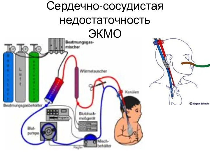 Сердечно-сосудистая недостаточность ЭКМО