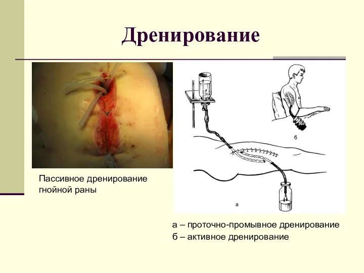 Дренирование Пассивное дренирование гнойной раны а – проточно-промывное дренирование б – активное дренирование