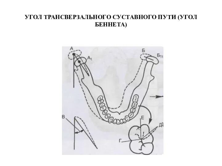 УГОЛ ТРАНСВЕРЗАЛЬНОГО СУСТАВНОГО ПУТИ (УГОЛ БЕННЕТА)